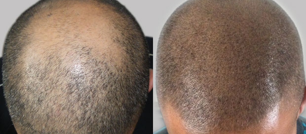 SMP Treatment
