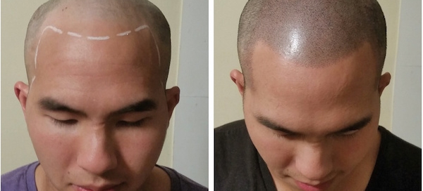 micropigmentation001